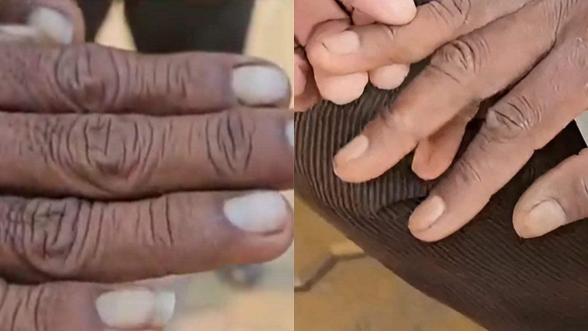 Maharashtra News: Initially Hair, Now Nails Are Shedding! Buldhana Continues To Face Mystery Ailments From Water Contamination (VIDEO) 